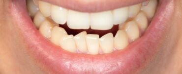 fix crooked teeth