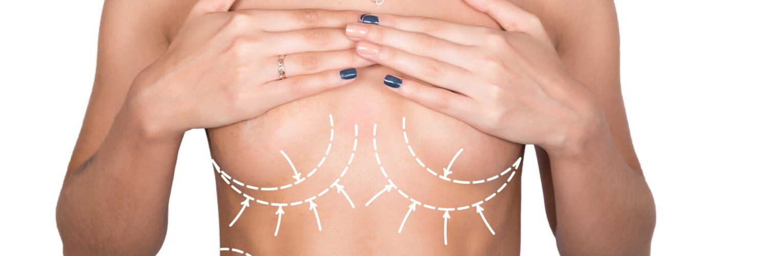 breast augmentation recovery week by week