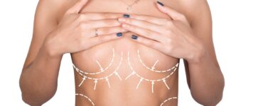 breast augmentation recovery week by week