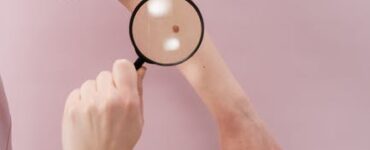 cost of mole removal