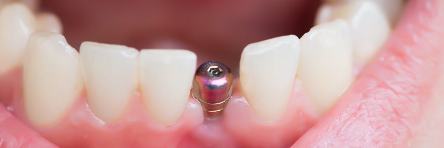 how to heal faster after dental implants