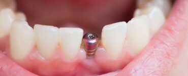 how to heal faster after dental implants