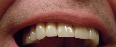 same-day dental crowns