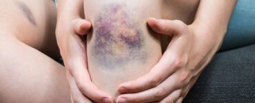 abrasion vs contusion