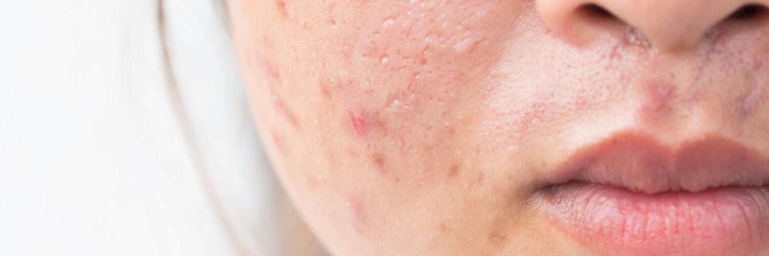 acne marks vs acne scars