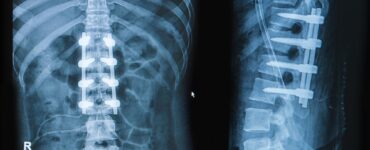 robotic spine surgery