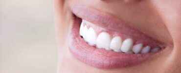 teeth bonding vs veneers