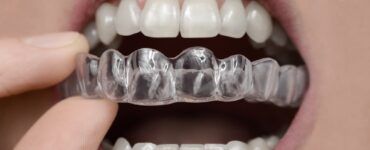 clear correct aligners