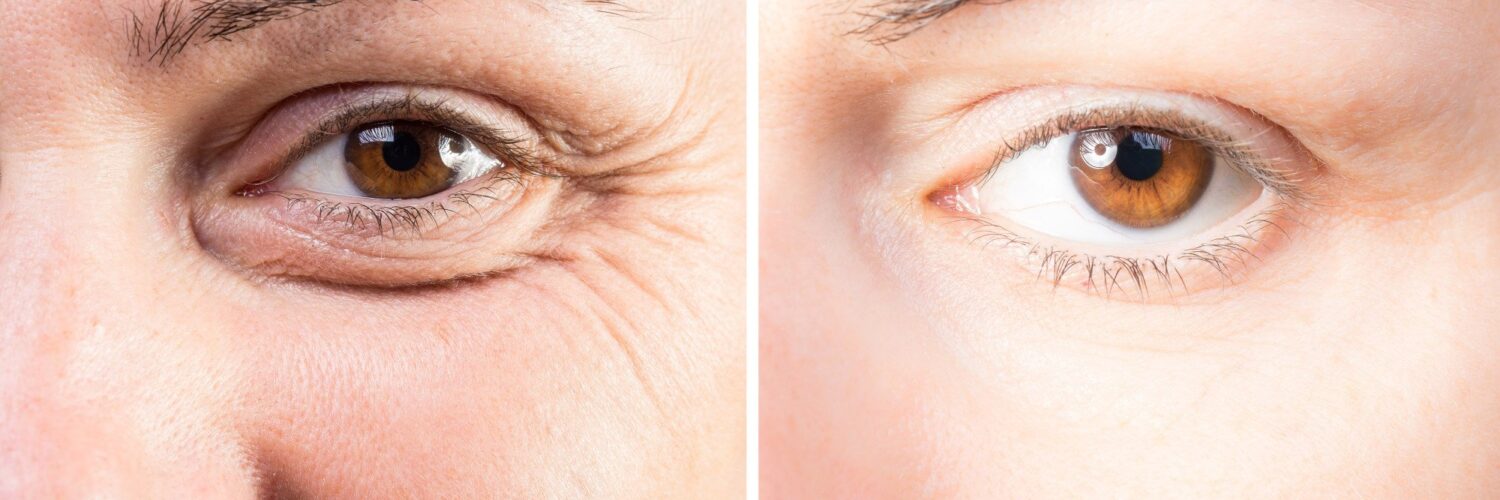how to qualify for eyelid surgery