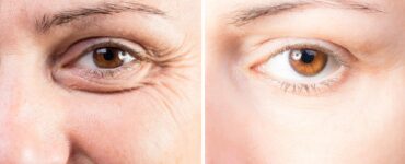 how to qualify for eyelid surgery