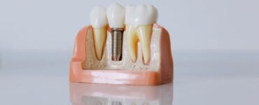 dental implant parts