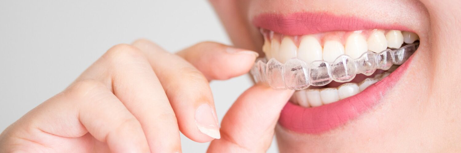 invisalign before and after