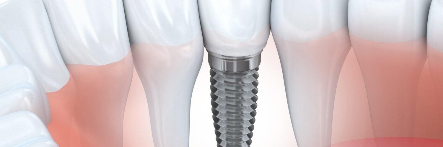 replacing a missing tooth