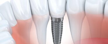 replacing a missing tooth