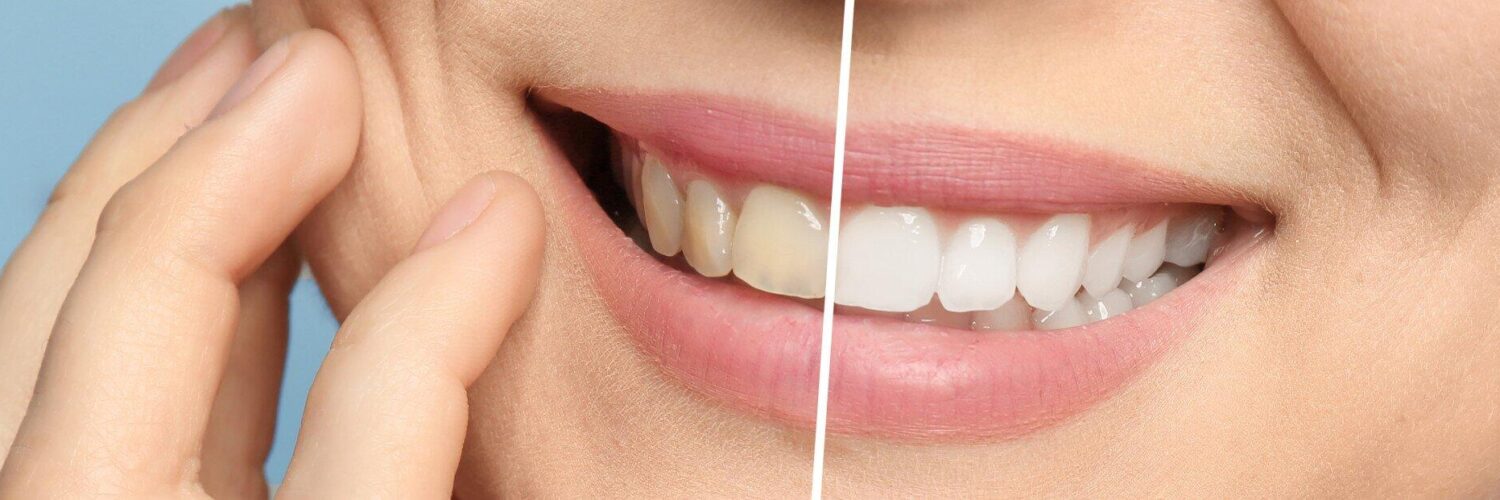 teeth whitening cost