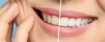 teeth whitening cost