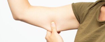 arm liposuction