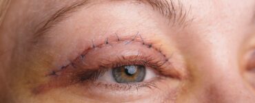 blepharoplasty before and after