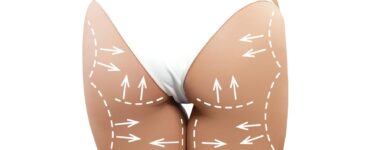 brazilian butt lift scars