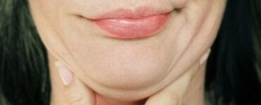 chin wrinkles treatment