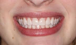 dental crowns for front teeth