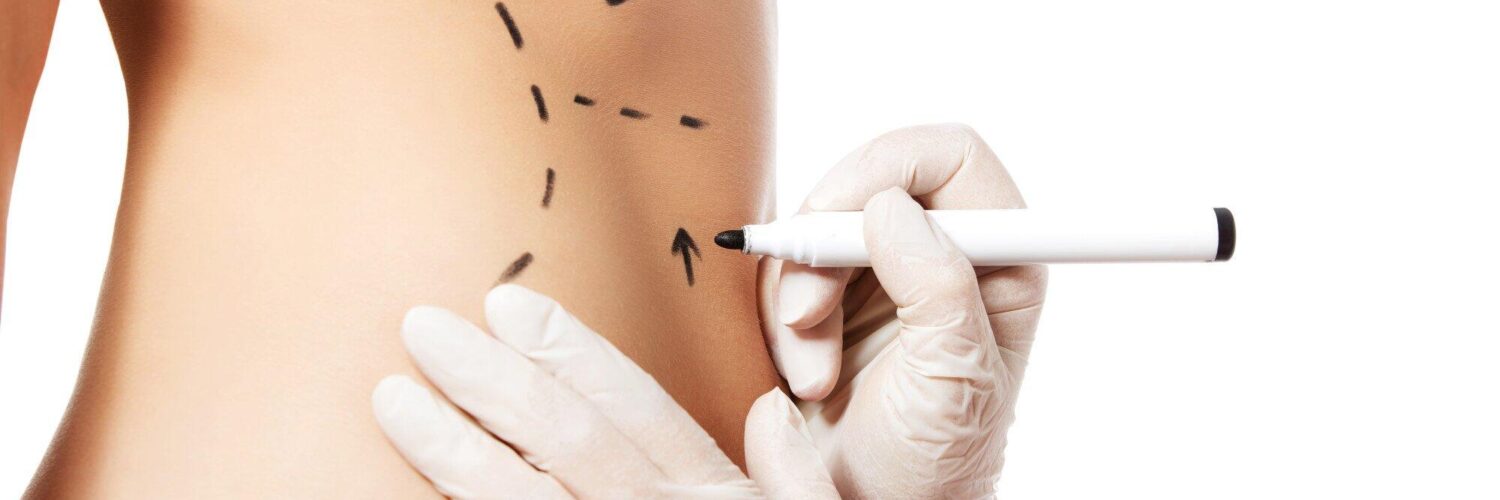 mini abdominoplasty
