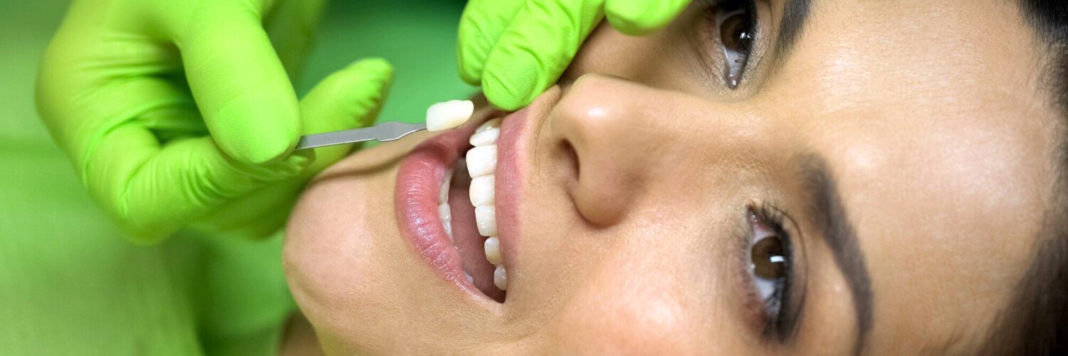 types of veneers and cost